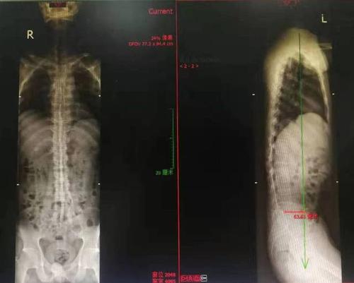 强直性脊柱炎脊柱融合