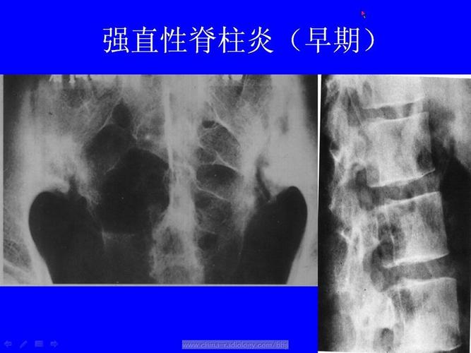 60岁强直性脊柱炎能治好吗