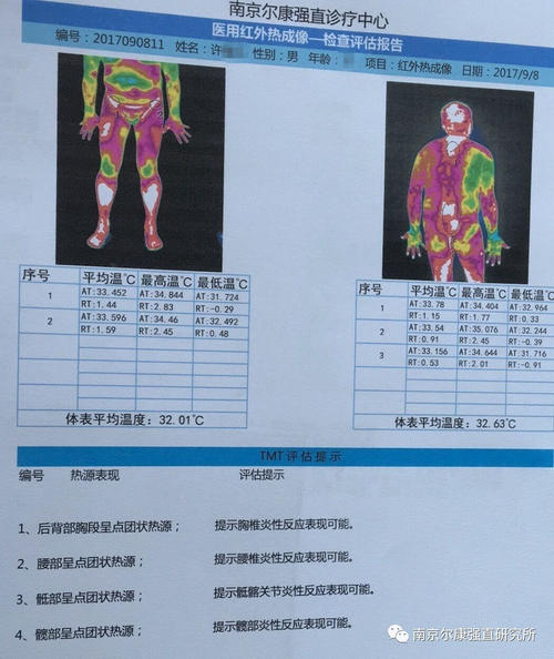 强直性脊柱炎怎么诊断