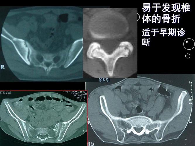 强直性脊柱炎早上游走性疼痛