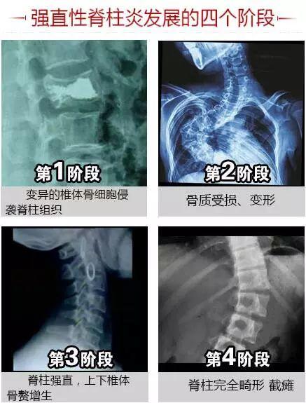 为什么强直性脊柱炎看不好