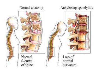 强直性脊柱炎导致的驼背怎么办