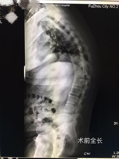 强直性脊柱炎x光片严重程度