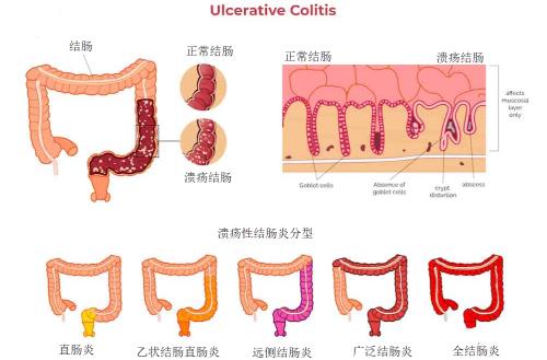溃疡性结肠炎是顽疾吗