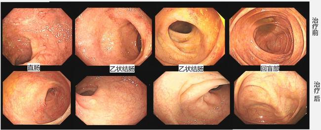 日本治疗溃疡性结肠炎