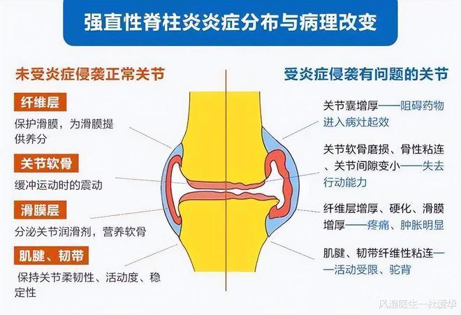 强直性脊柱炎诱发因素