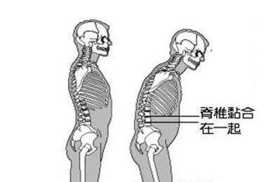 强直性脊柱炎如何找专业人锻炼