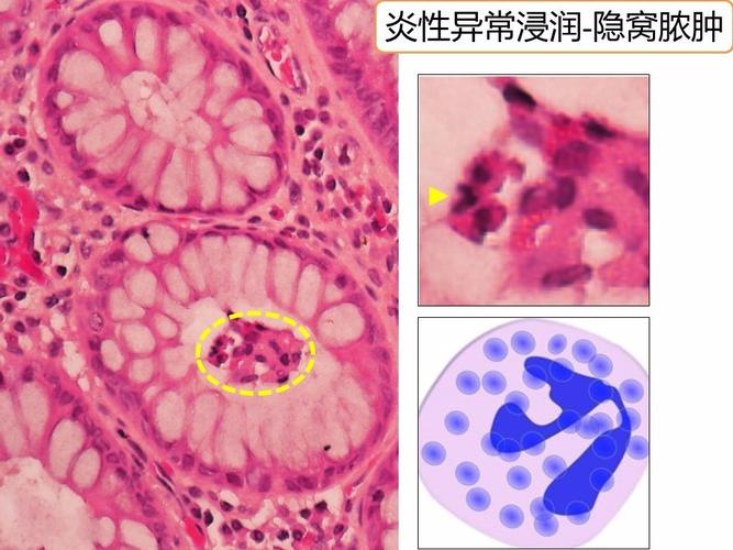 婴儿溃疡性结肠炎影响生长发育