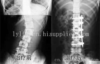 强直性脊柱炎20年还发展吗