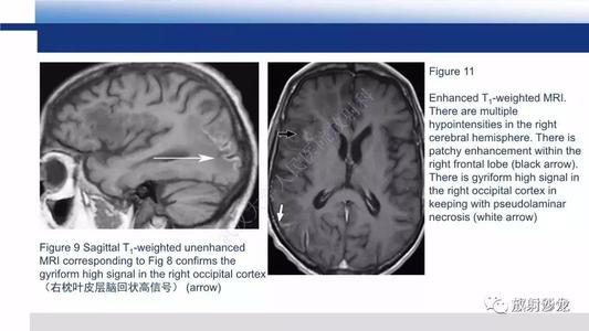 原发性中枢神经系统淋巴瘤