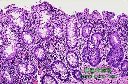 溃疡性结肠炎分类