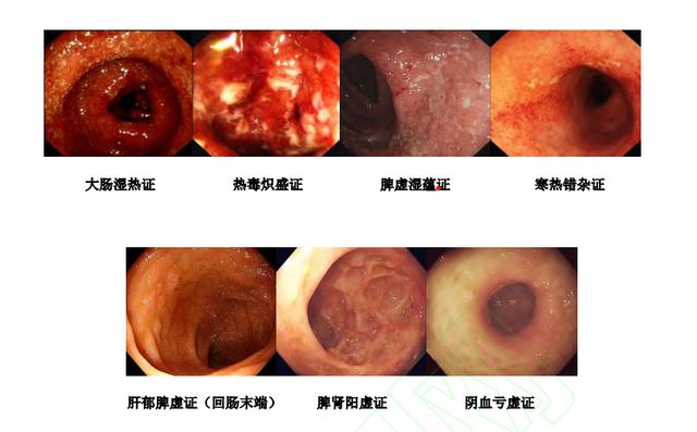 升结肠浅溃疡和溃疡性结肠炎