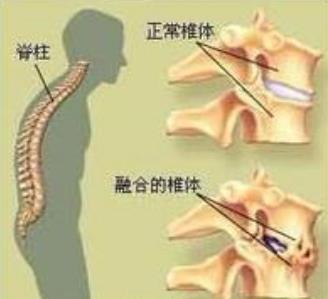 强直性脊柱炎疗效指标