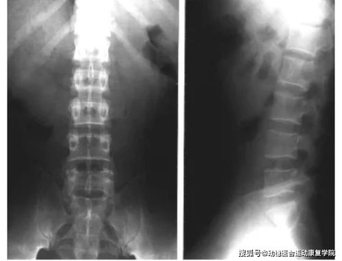 武汉治疗强直性脊柱炎