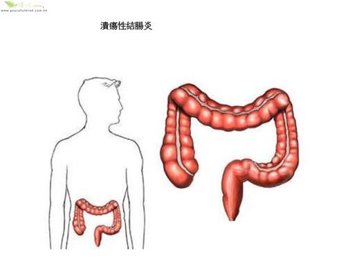 慢性结肠炎也叫溃疡性结肠炎