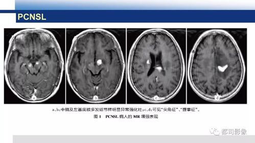 原发性中枢神经系统淋巴瘤