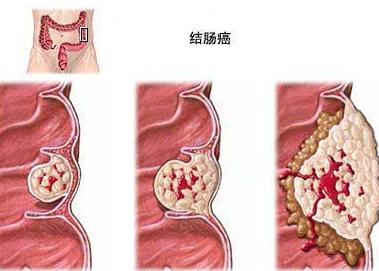 溃疡性结肠炎补充维生素吗