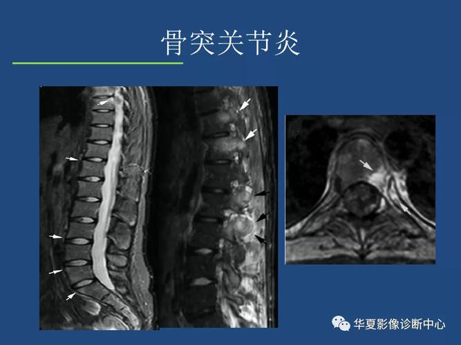 鉴定强直性脊柱炎需要做哪些证明