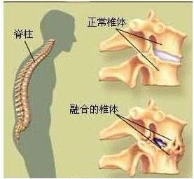 强直性脊柱炎可以查神经科嘛