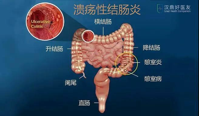 溃疡性结肠炎静止期