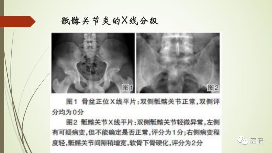 杨清锐强直性脊柱炎