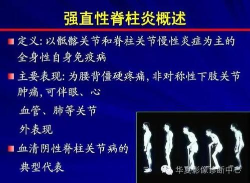 在什么情况强直性脊柱炎不能报销