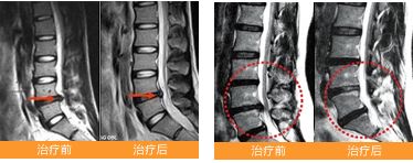 强直性脊柱炎激素过度导致瘫痪