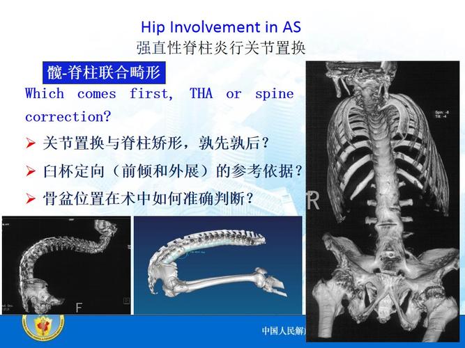 髋关节强直性脊柱炎滑膜炎