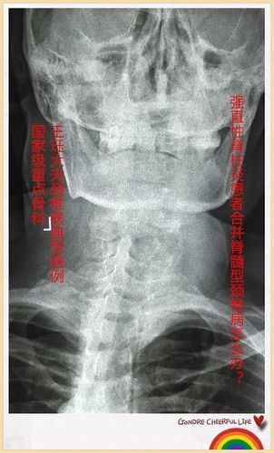 脊柱性肌肉萎缩症和强直性脊柱炎