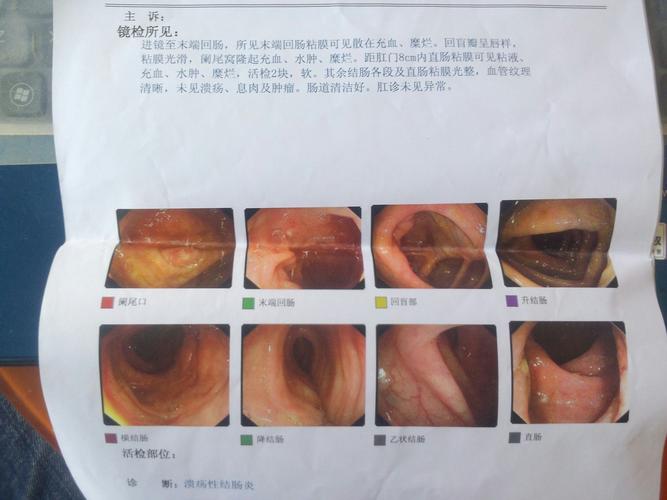 溃疡性结肠炎复发期可以喝麦片吗