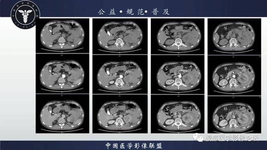 弥漫性大B细胞淋巴瘤