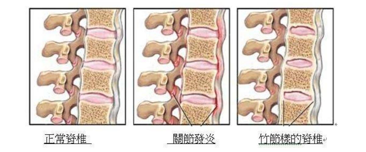 怀孕期间强直性脊柱炎疼痛怎么办