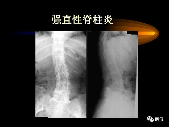 强直性脊柱炎最常受累关节