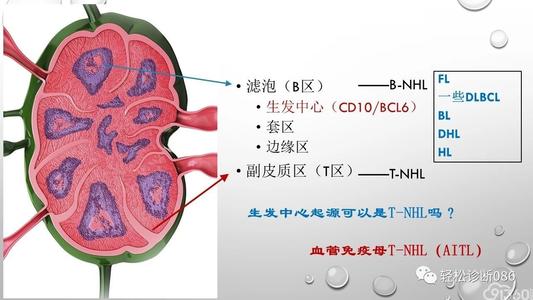 血管免疫母细胞性T细胞淋巴瘤