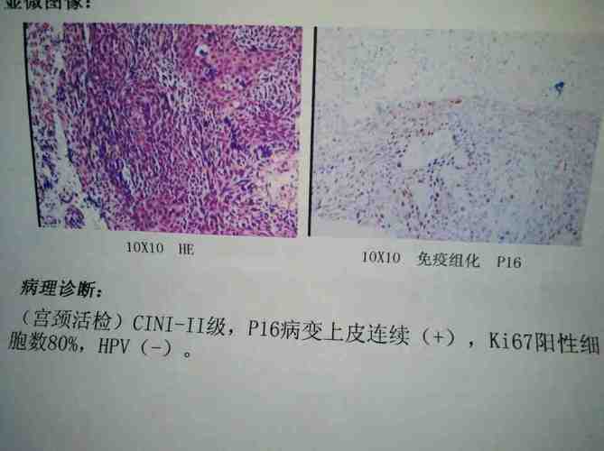 hpv病毒引起溃疡性结肠炎