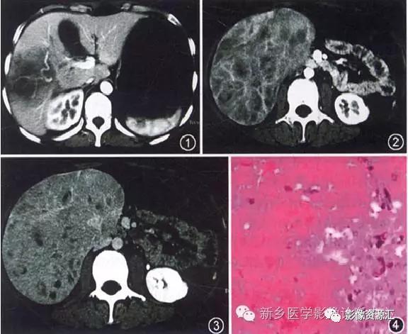 溃疡性结肠炎ct图片