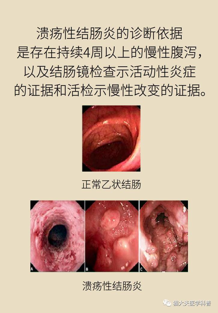 溃疡性结肠炎误诊