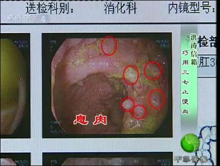 激素治疗溃疡性结肠炎无效