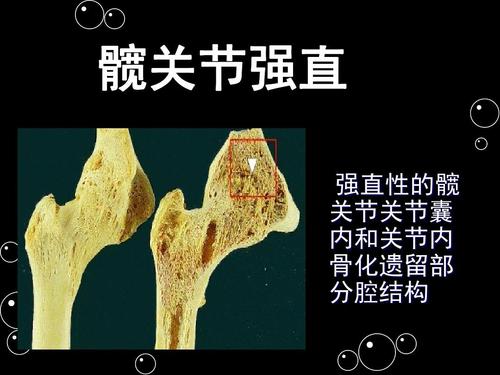 强直性脊柱炎生物制剂修美乐家