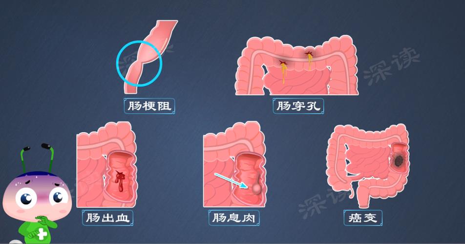 溃疡性结肠炎为什么做一点点事情就会肚子疼