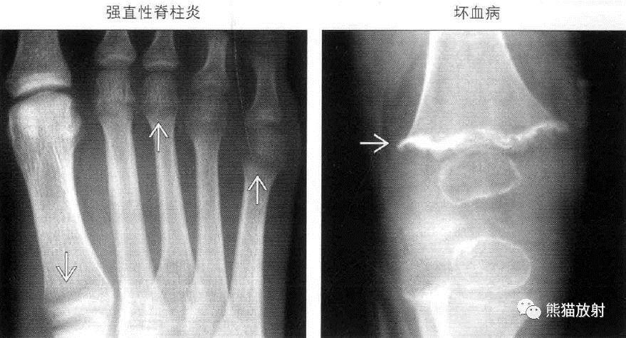 强直性脊柱炎手指痛怎么办