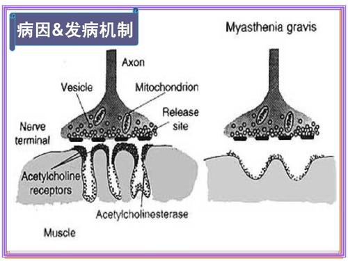 重症肌无力