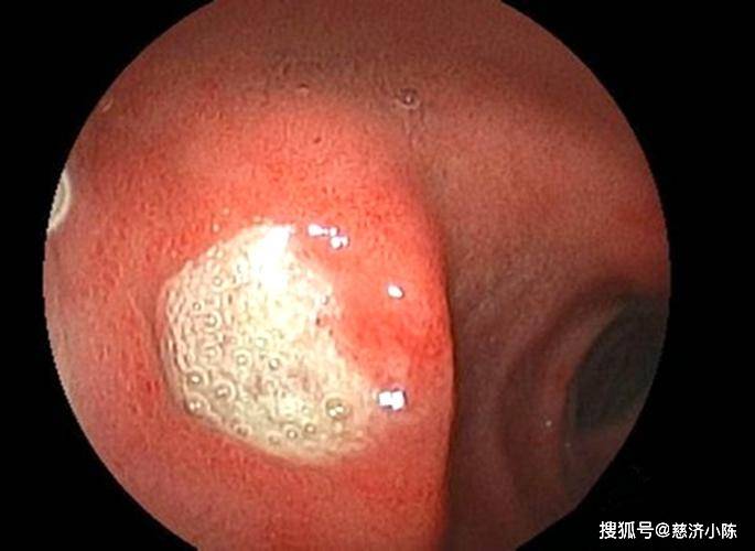 重度溃疡性结肠炎最好治疗方法