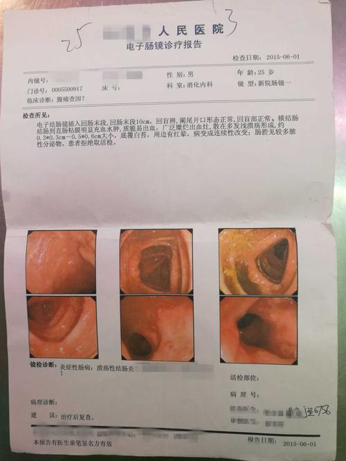 右中侧腹痛是溃疡性结肠炎吗