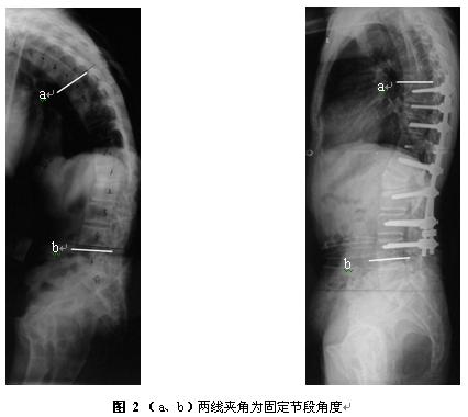 强直性脊柱炎的宝妈