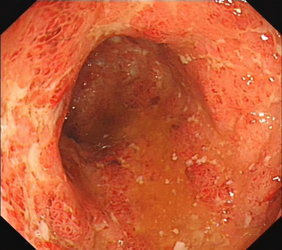 溃疡性结肠炎活动期的病理表现