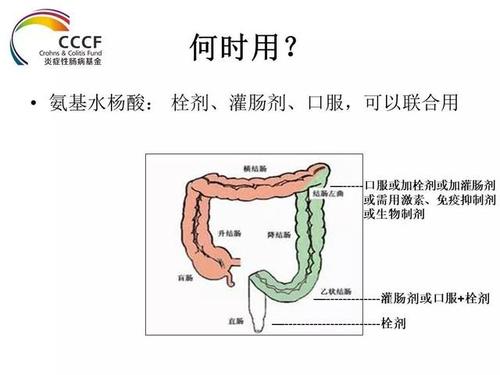 溃疡性结肠炎属于重病吗