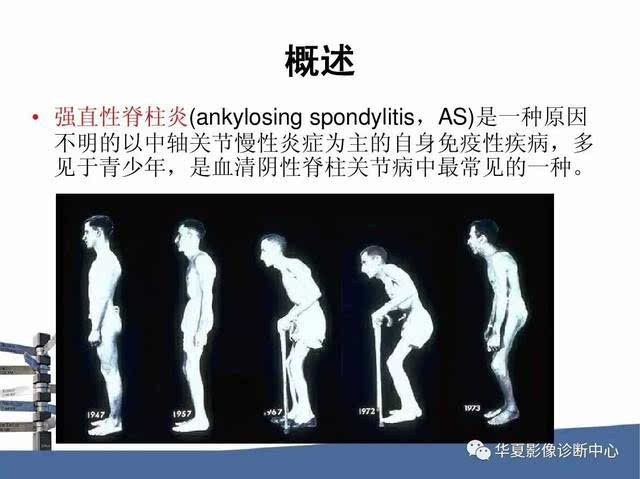 双侧二级改变强直性脊柱炎