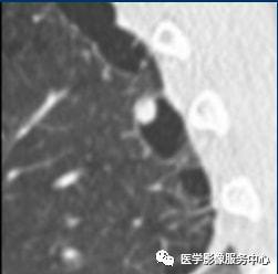 肺囊性纤维化