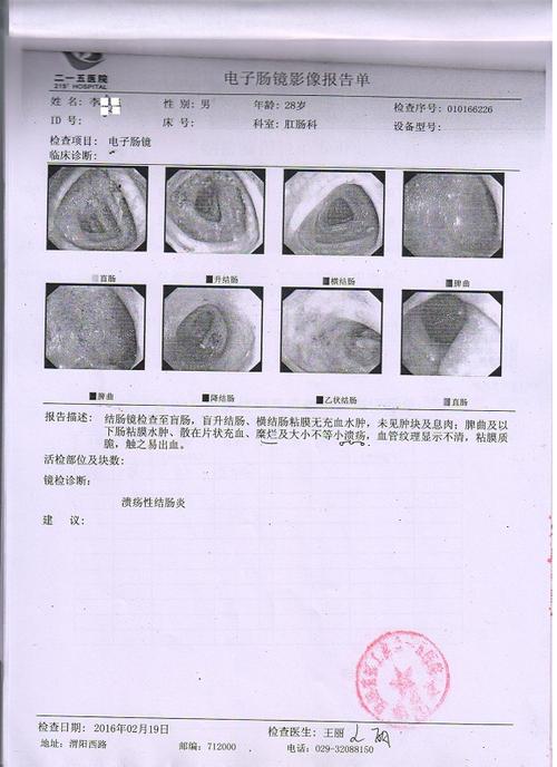 溃疡性结肠炎大便